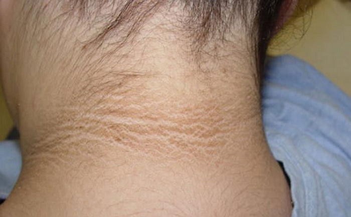 목 뒤 ‘검은 튼살’ 있다면 ‘병원’에 꼭 가야 하는 이유 (사진)