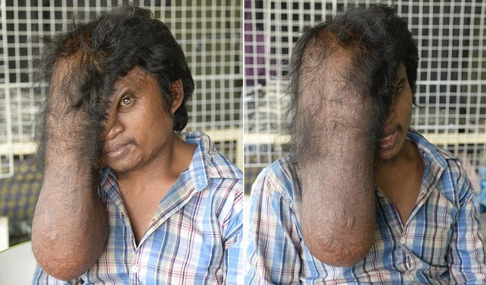 ‘혹부리 노숙자’ 위해 모금 운동 나선 호주인 부부