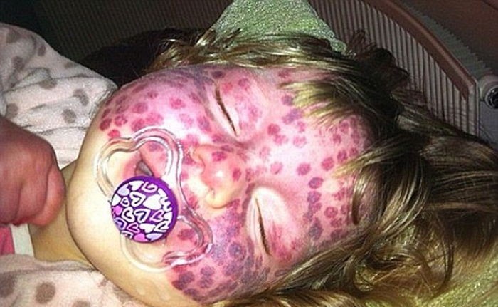 희귀병으로 얼굴에 붉은 물방울 무늬 생긴 소녀