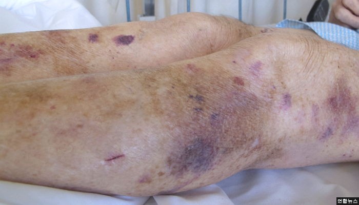 매질로 말 근육처럼 허벅지 부어… 목사부부 ‘살인죄’