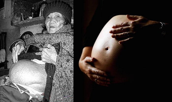 돈이 없어 60년간 죽은 ‘태아’ 품고 살아온 92세 할머니 (사진)