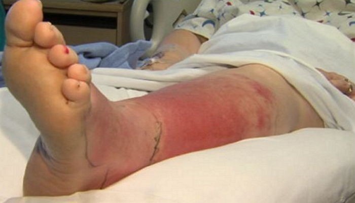 네일숍서 페디큐어 받았다가 다리 절단 위기 놓인 여성