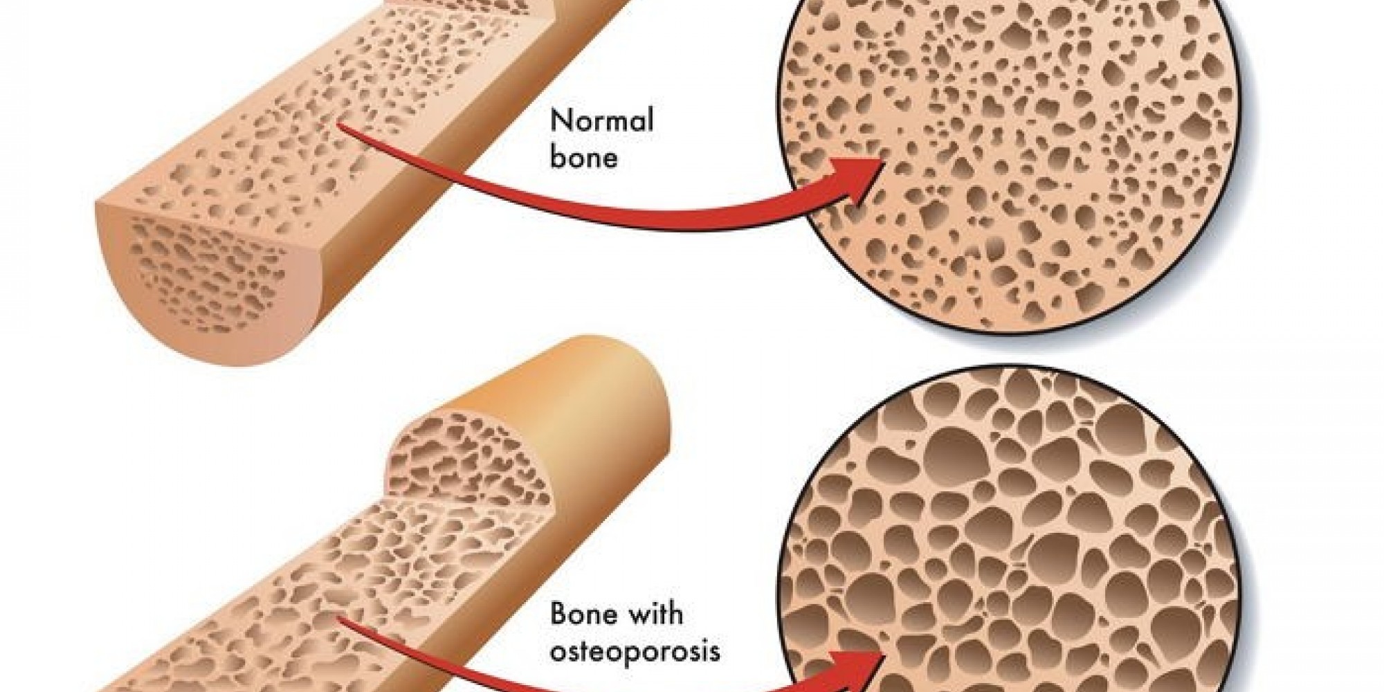 콜라를 계속 마시면 당신의 뼈는 이렇게 된다 인사이트