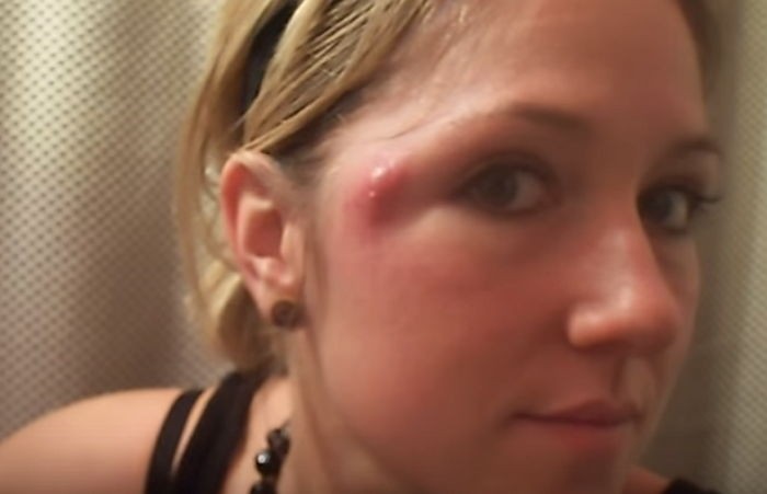 “여친 얼굴에서 ‘괴물’ 여드름이 폭발했어요” (영상)