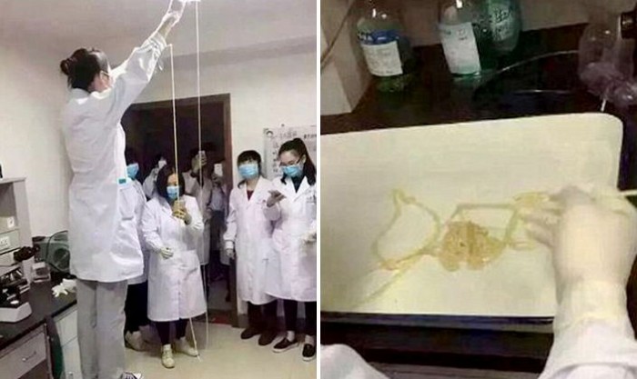 날것 즐겨 먹던 남성 배에서 나온 5미터 ‘기생충’