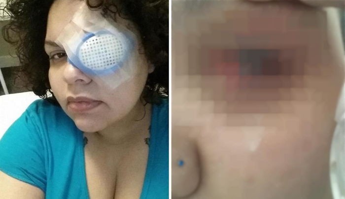 ‘반짝이 가루’ 눈에 들어갔다가 실명한 여성