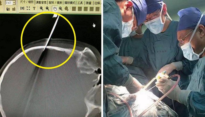 숙제 안했다고 딸 머리에 ‘가위’ 박은 아빠