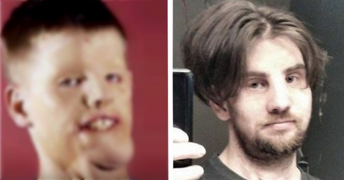 3도 화상으로 ‘얼굴 이식’ 받은 남성의 근황 (영상)