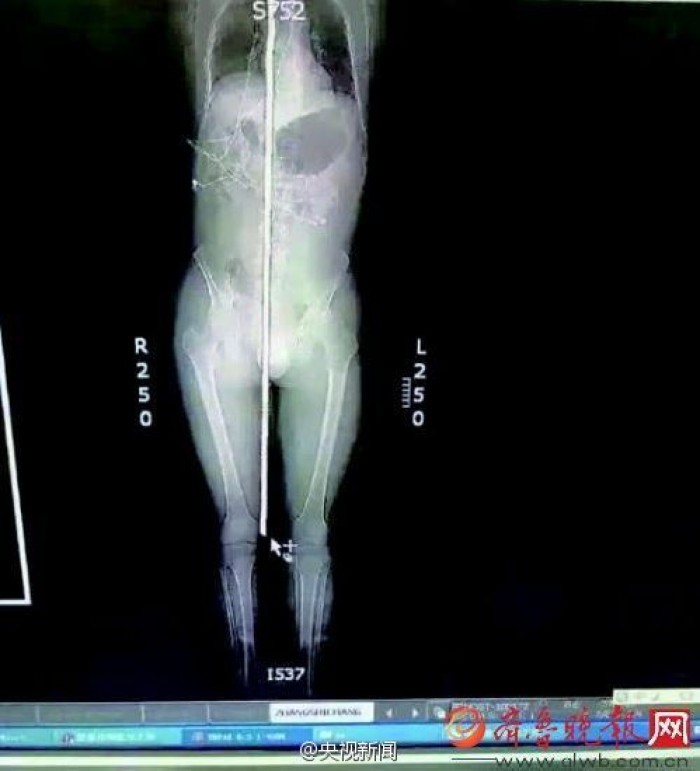 1.5m 철근 ‘관통’하고도 살아남은 기적의 사나이 (사진)