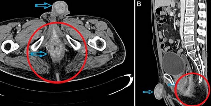 ‘변비’ 때문에 병원 갔다가 성기에 생긴 ‘암’ 발견한 남성