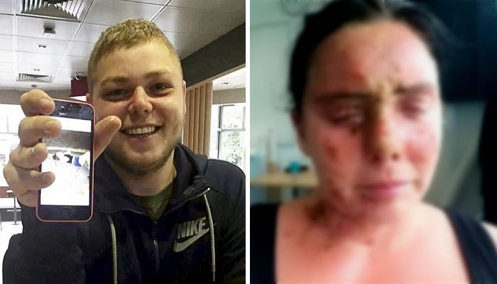 ‘염산 테러’ 당한 여성 인증샷 들고 셀카 찍은 범인