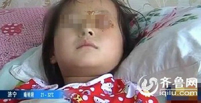 중국산 ‘케이크’ 장식 폭발해 실명 위기 처한 6살 소녀