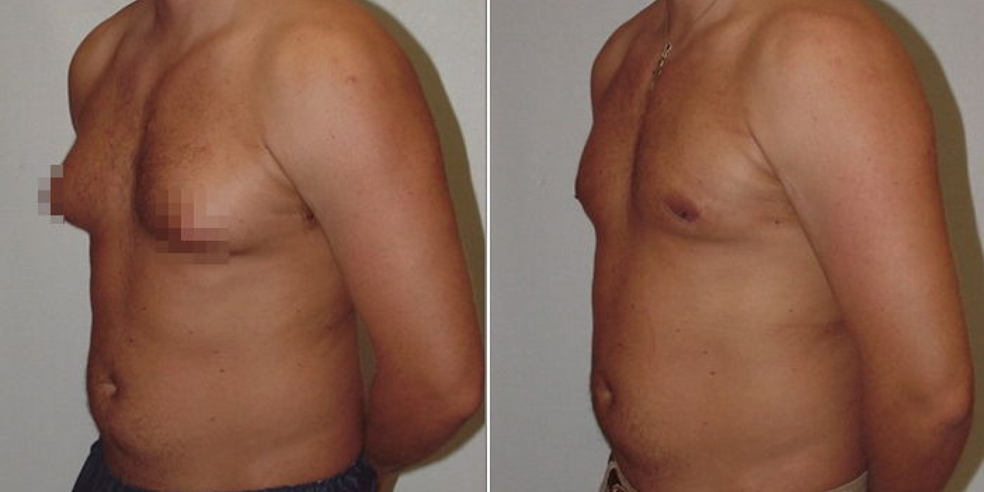 удаления жира из груди у мужчин фото 19