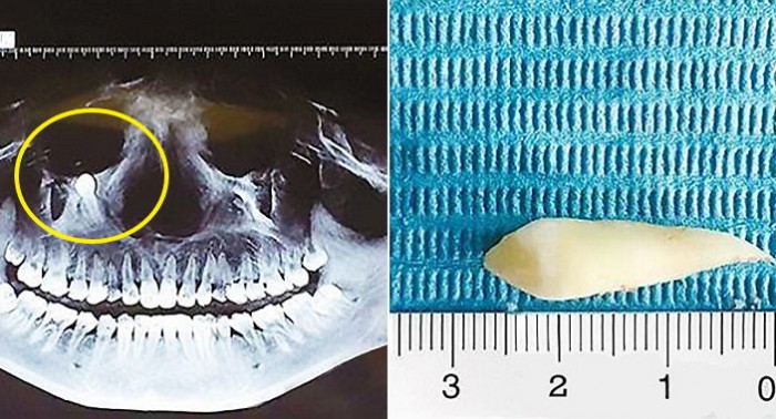 눈 바로 밑에 ‘2.5cm’ 뾰족 치아 자란 여성