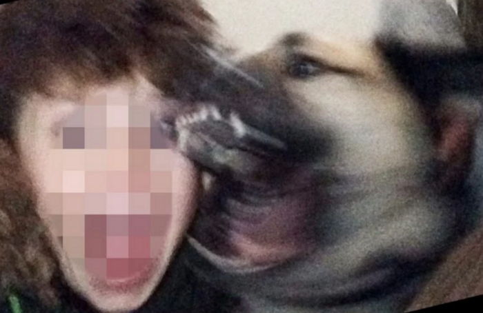 셀카 찍다 친구 반려견에 물려 21바늘 꿰맨 소년