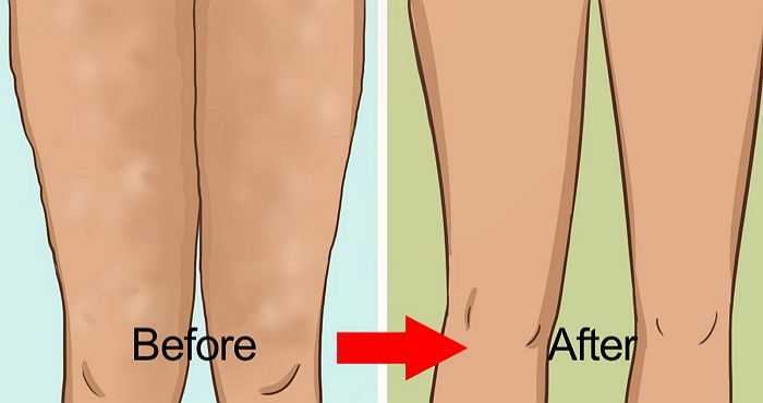 울퉁불퉁 ‘셀룰라이트’ 말끔히 없애주는 5가지 방법