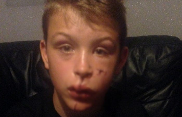 목줄 풀어놓은 친구 집 강아지에 물려 80바늘 꿰맨 소년