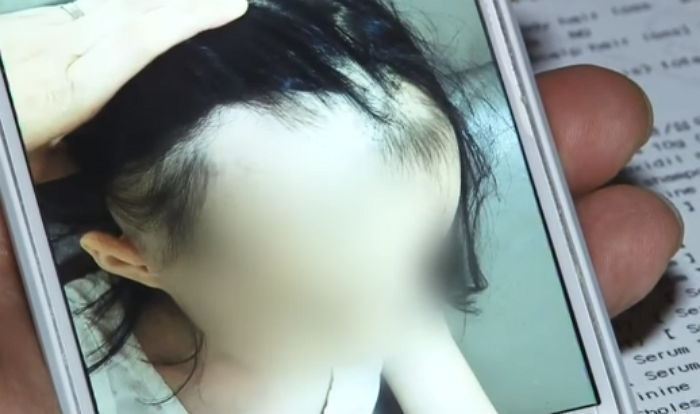 ‘어린이 탈모’ 보도에 한약 제조한 한의원이 내놓은 반박글