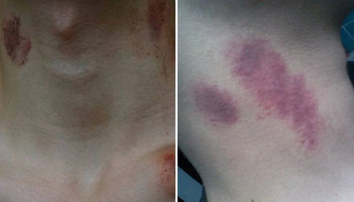 여자친구와의 격렬 ‘키스’ 뒤 사망한 10대 소년