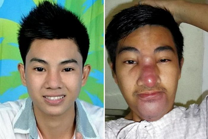 ‘높은 코’ 가지고 싶어 불법시술 받다 ‘코봉이’된 남성