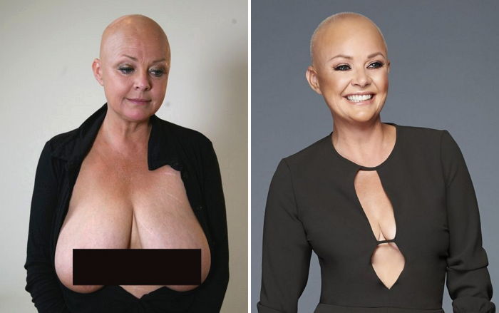 “큰 가슴이 내 인생을 망쳤다”…거대 가슴 축소 수술한 여성