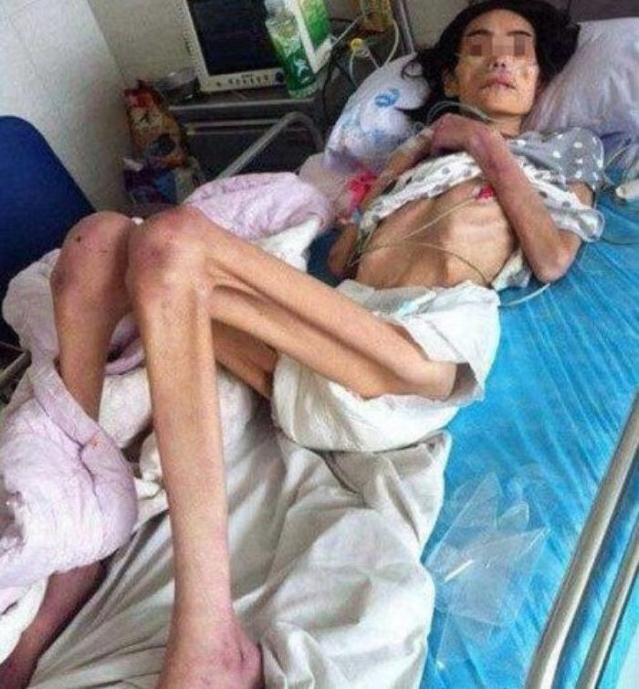 바람피운 남편과 시어머니 학대로 몸무게 ‘18kg’된 여성