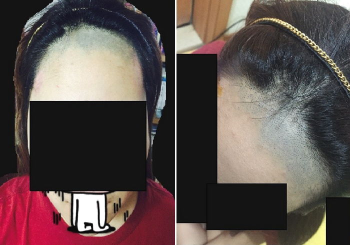 “미용실서 제 앞머리를 ‘바리깡’으로 싹 밀어버렸습니다”