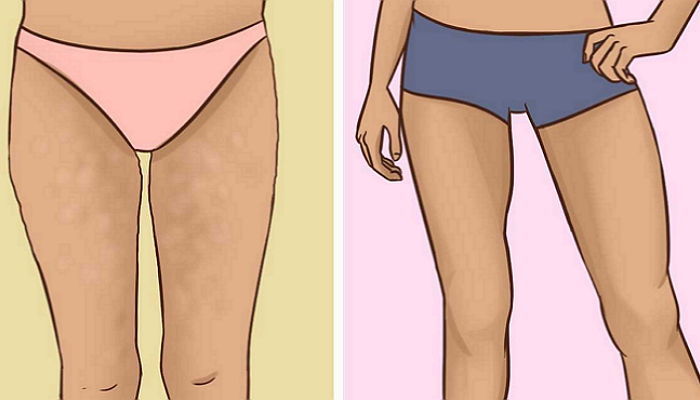 울퉁불퉁 허벅지 셀룰라이트 매끈하게 만들어 줄 운동 8개