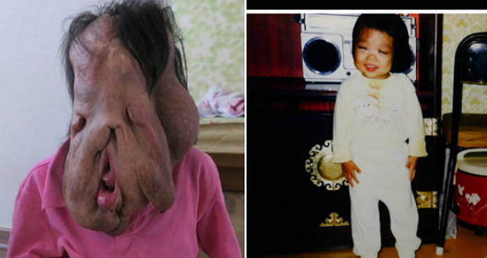 현희씨 방송 이틀만에 ‘후원금 9억’ 모였지만 쉽지않은 수술 앞뒀다