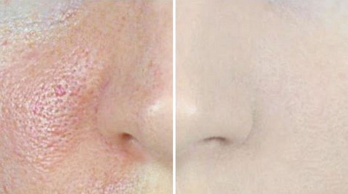 울퉁불퉁 모공 없애 ‘깐달걀 피부’ 만들어 줄 꿀팁 5가지