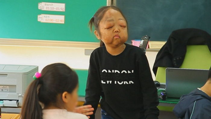 신경섬유종으로 종양이 얼굴을 뒤덮은 10살 소녀 여진이