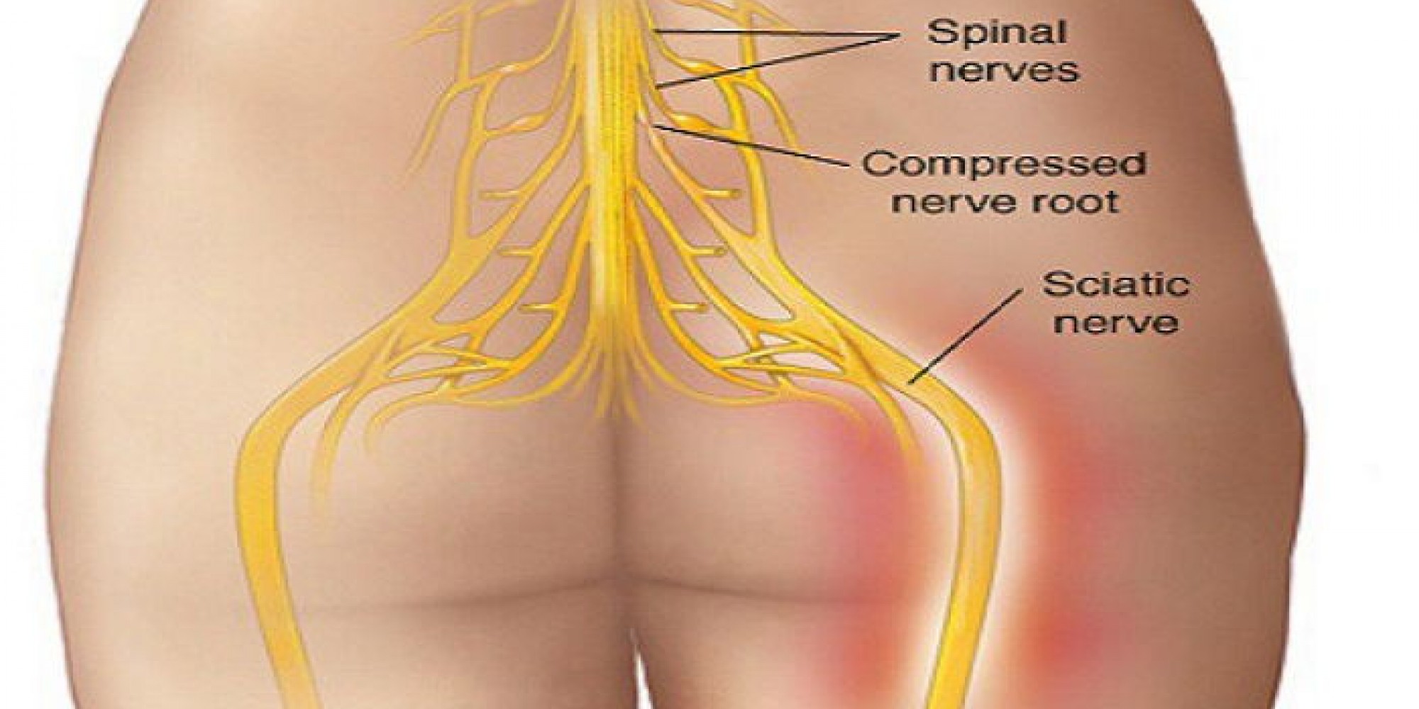 Симптомы боли седалищного нерва у мужчин. Нерв в ягодице. Неврит седалищного нерва. Защемление седалищного.