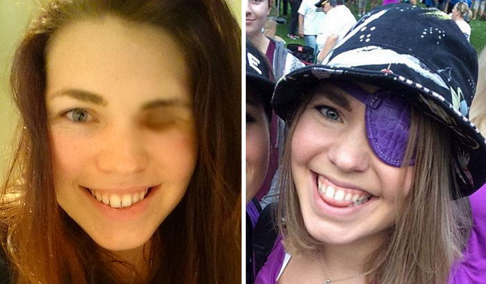 암으로 한쪽 눈 제거하고도 희망 잃지 않은 여성