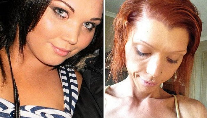 ‘성인 배우’ 몸매 원한다는 남친 말에 살 빼다 거식증 걸린 여성