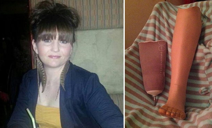 ‘12cm’ 킬힐 신고 춤추다 생긴 물집 때문에 다리 절단한 여성