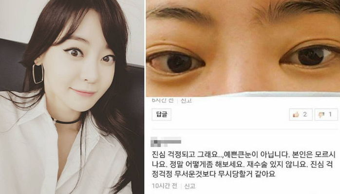 ‘눈 앞트임 성형 의혹’에 자신의 희귀병 고백한 서유리