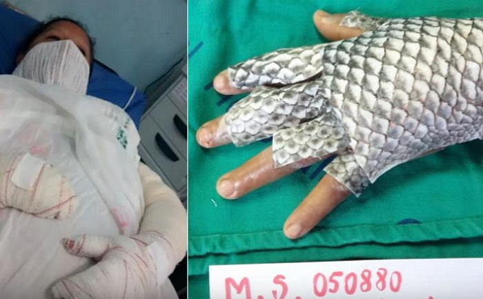 세계 최초로 ‘물고기 피부’ 붕대 감은 화상 환자