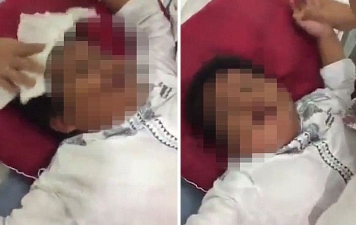 ‘포경 수술’ 중 성기 반으로 잘린 10살 소년