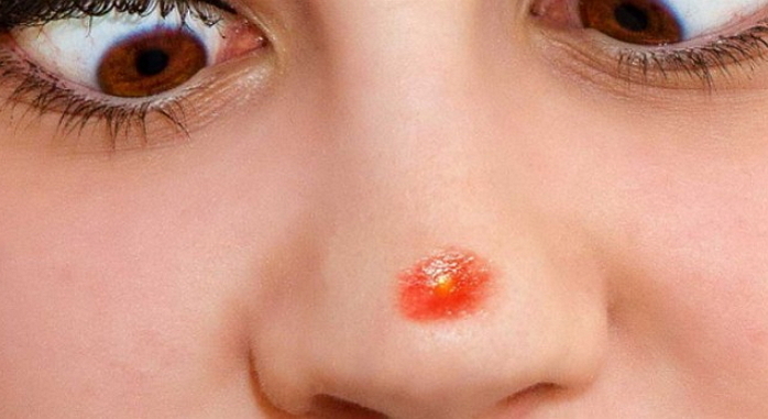 “제발 이곳만은” 여드름 안 생겼으면 하는 얼굴 부위 3