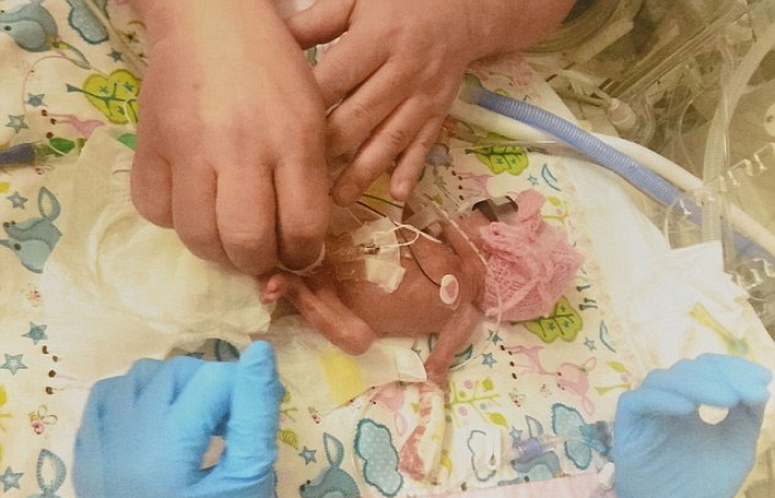 죽는다는 의사 말에도 기적처럼 살아난 ‘623g’ 미숙아