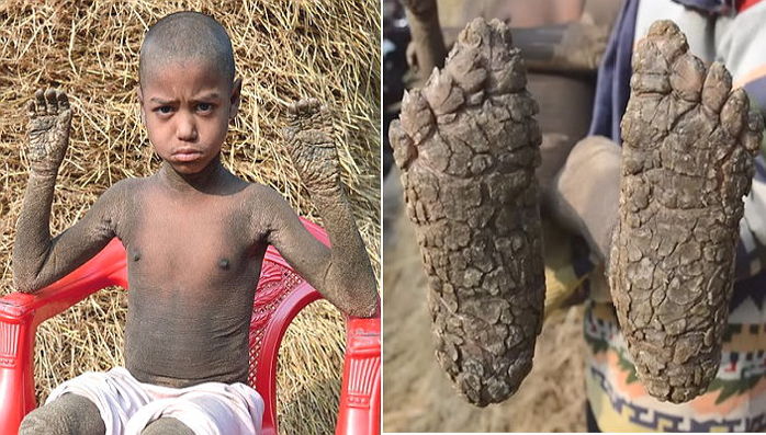 피부가 ‘돌’처럼 딱딱하게 굳는 희귀병으로 고통받는 소년