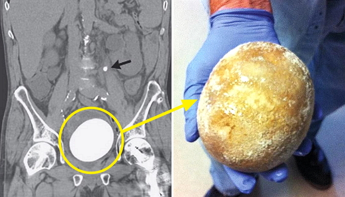 소변 볼 때 통증 느낀 남성 방광에서 발견된 ‘타조알’ 크기 결석