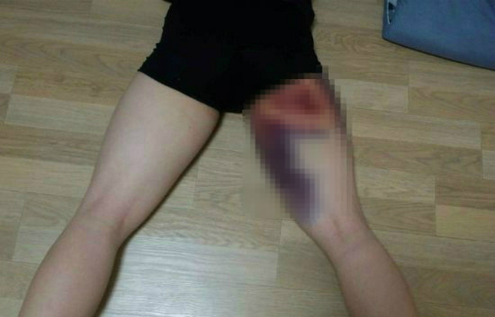 허벅지에 ‘피멍’ 들 때까지 학생 폭행한 야구부 코치