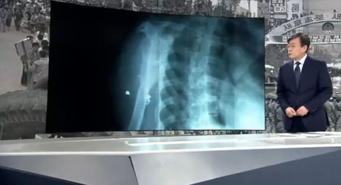 5·18 계엄군한테 맞은 납탄 파면 ‘37년’ 동안 몸에 안고 사는 시민들