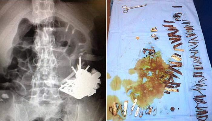 수십년 동안 칼날 삼킨 남성의 배속에서 나온 100여개의 금속
