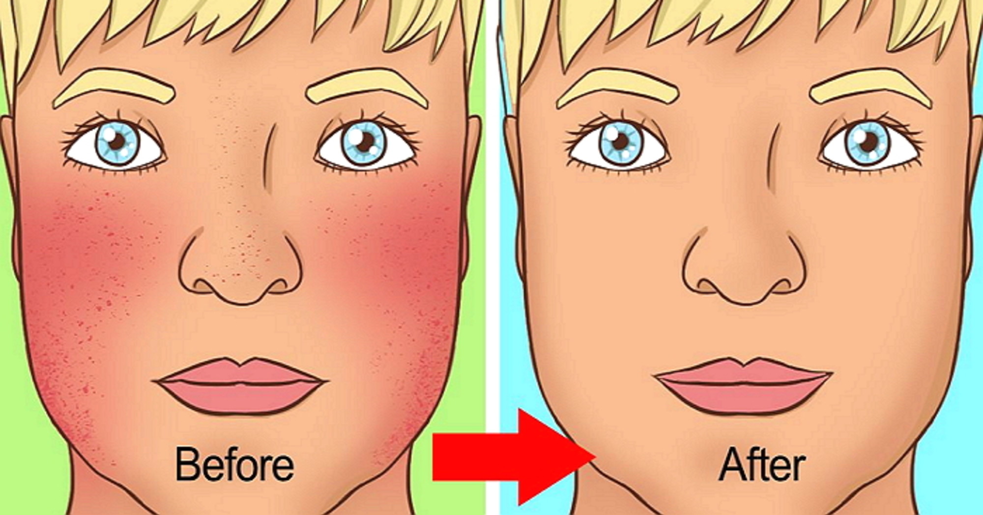 Розацеа схема