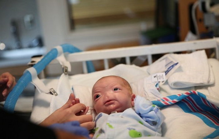 코 없이 태어났지만 항상 밝게 웃던 아기, 하늘나라로 떠났다