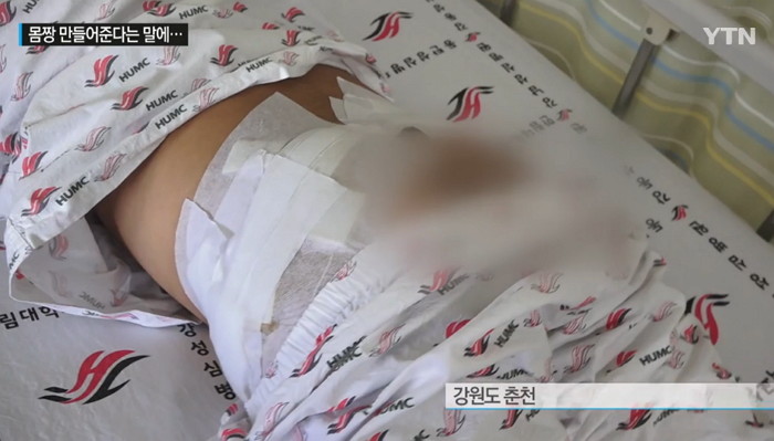 ‘불법 유통’ 스테로이드제 맞고 ‘근육 괴사’된 10대