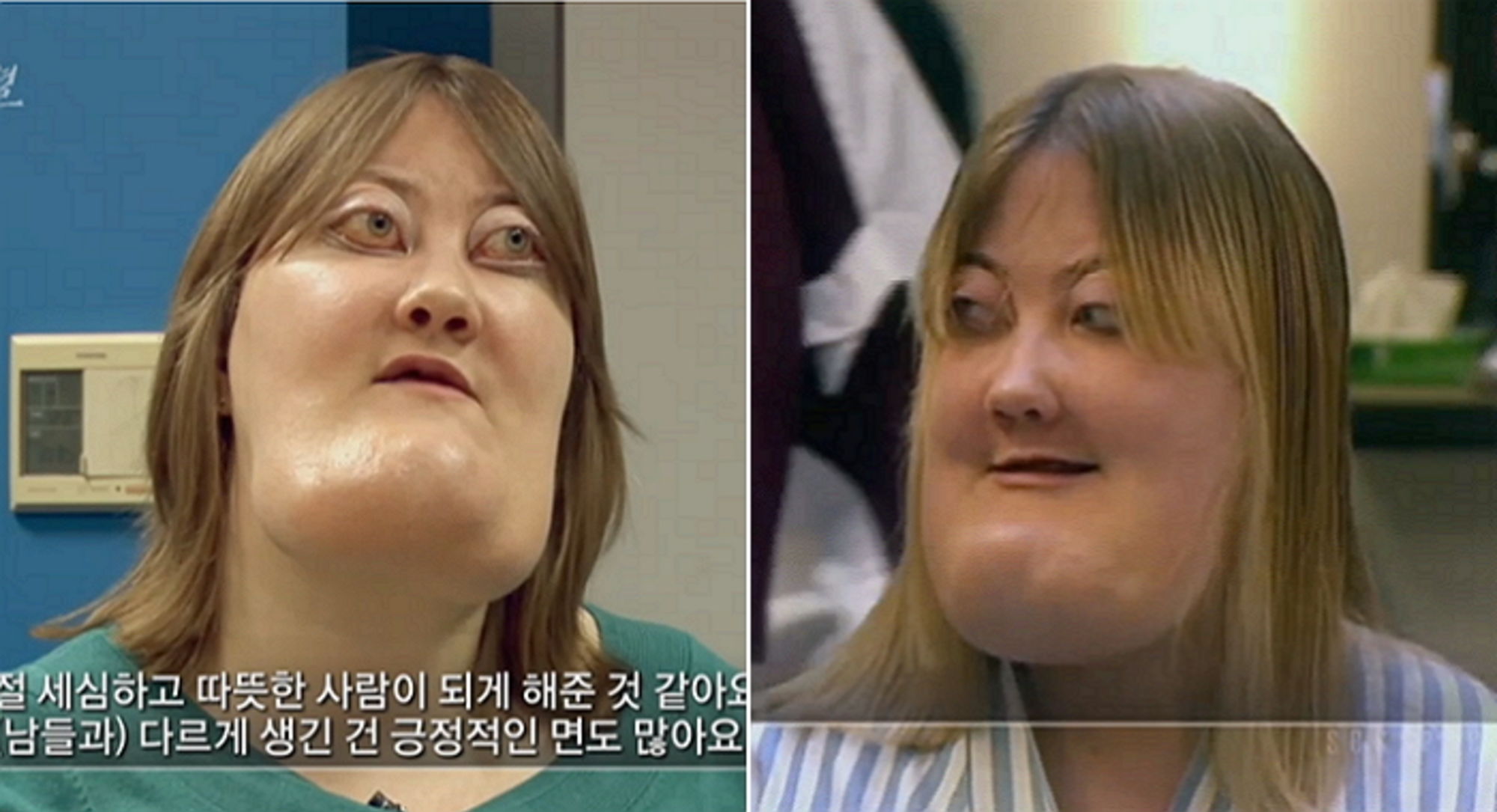 거대한 턱을 가진 여성이 ‘양악 수술’을 거부하는 이유 인사이트