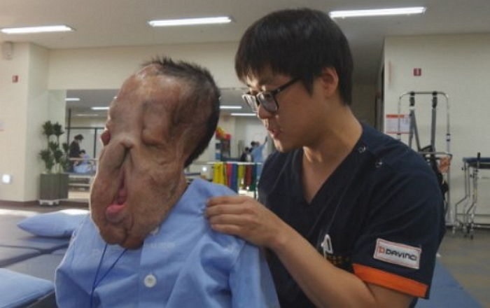 ‘신경섬유종’ 앓는 심현희 씨, ‘1kg 종양’ 제거수술 후 근황